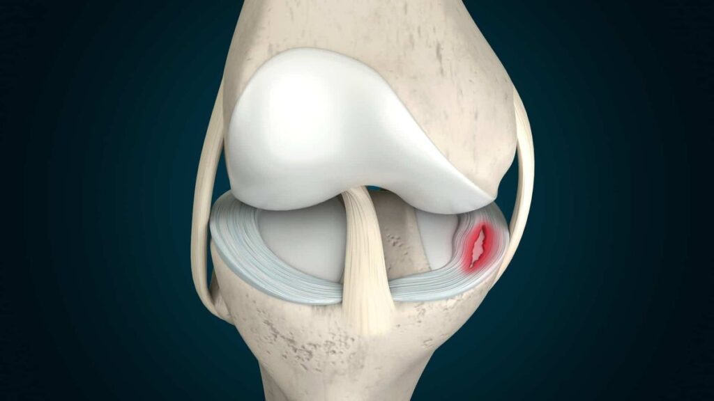 Meniscus Tear Symptoms: Early Warning Signs, Causes, Diagnosis, Treatment, and Recovery