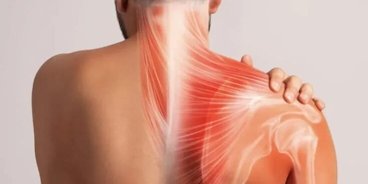 Shoulder Subluxation
