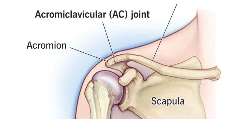 AC joint separation AC joint separation