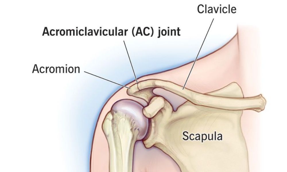 AC Joint Separation: Symptoms, Causes, Treatment, Recovery & When Surgery Is Needed
