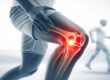 Can You Walk With a Torn ACL
