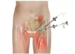 Hip Arthro