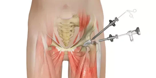 Hip Arthro
