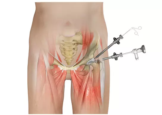 What Is Hip Arthro? A Complete Guide to Hip Arthroscopy, Recovery & Benefits