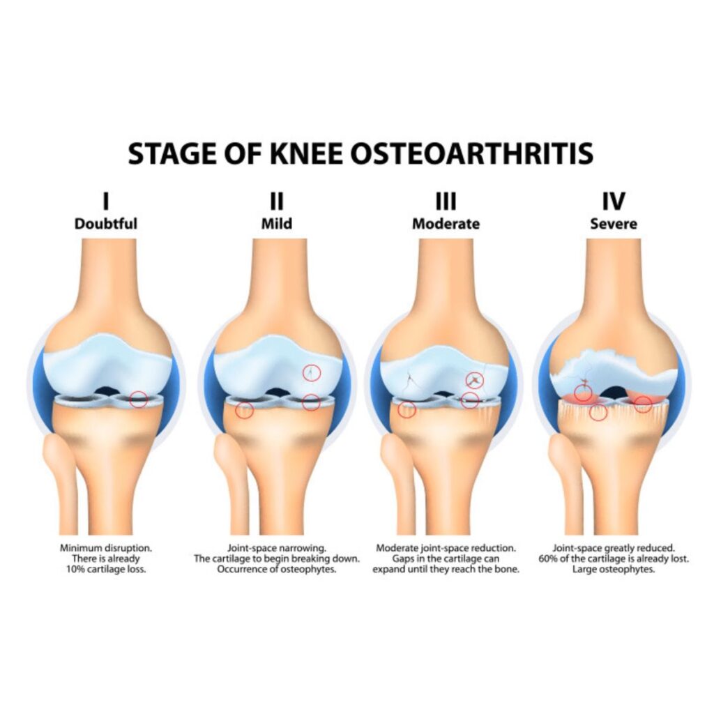 What Causes Knee Pain? A Clear Guide to Common Causes and Next Steps