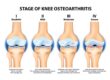 What Causes Knee Pain? A Clear Guide to Common Causes and Next Steps