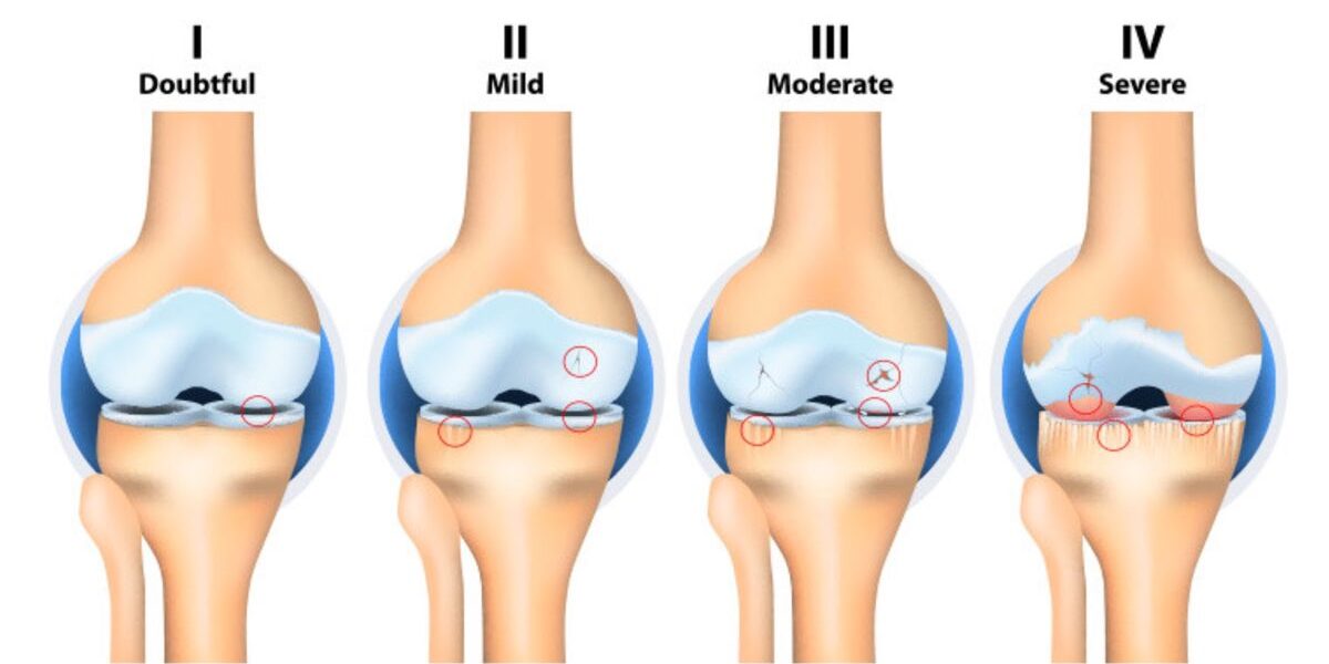 What Causes Knee Pain? A Clear Guide to Common Causes and Next Steps