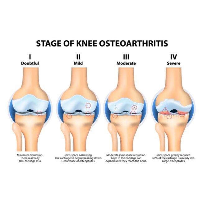 What Causes Knee Pain? A Clear Guide to Common Causes and Next Steps