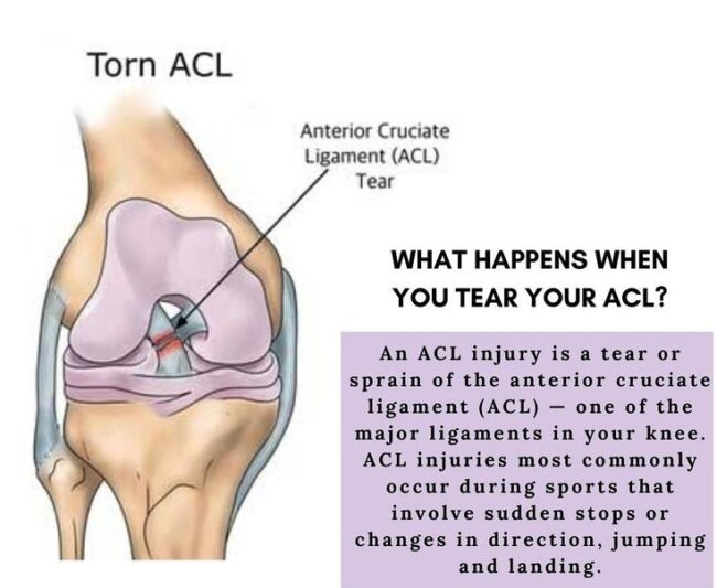 How Long Does an ACL Tear Take to Heal?
