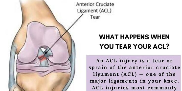 How Long Does an ACL Tear Take to Heal?