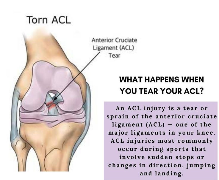 How Long Does an ACL Tear Take to Heal?