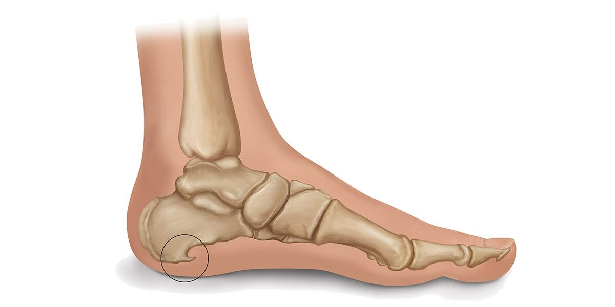 Heel Spur: Causes, Symptoms, and Treatment Options Explained Heel Spur: Causes, Symptoms, and Treatment Options Explained