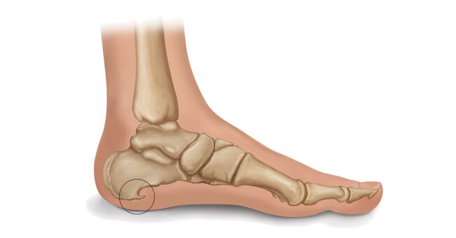 Heel Spur: Causes, Symptoms, and Treatment Options Explained Heel Spur: Causes, Symptoms, and Treatment Options Explained