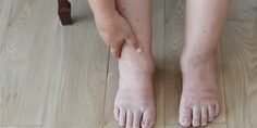 Swollen Ankle: Causes, Symptoms, Treatment, and When to See a Doctor