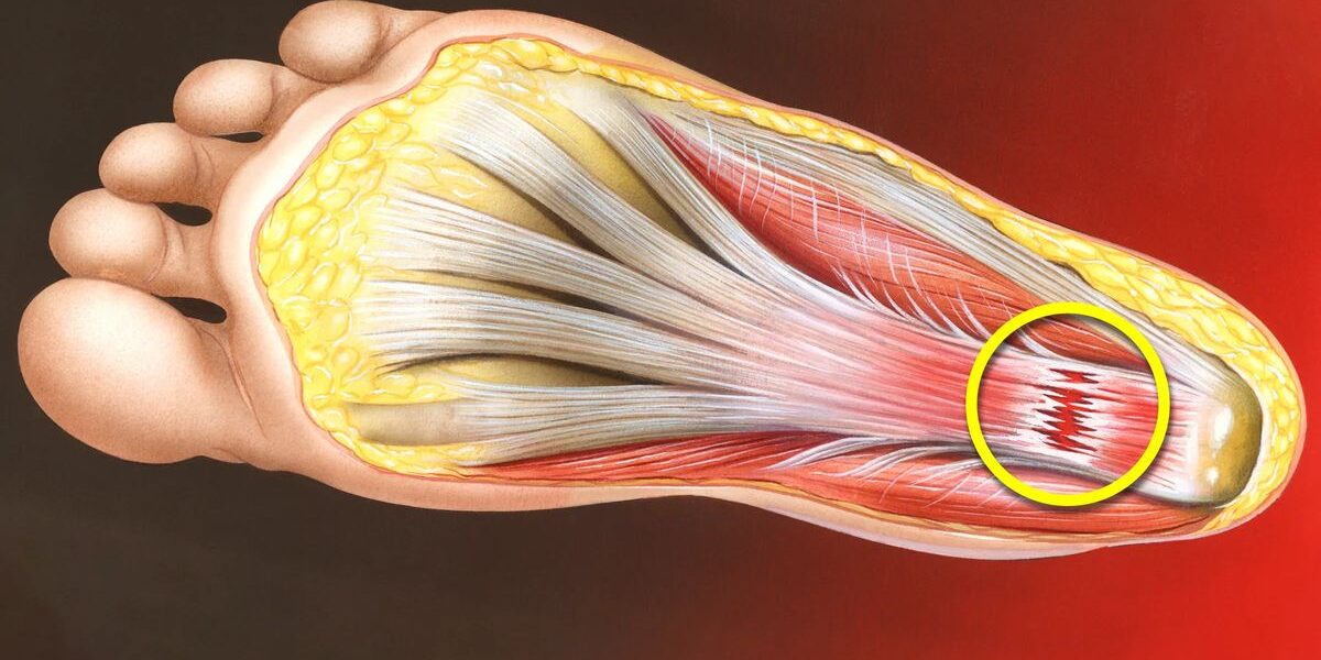 Plantar Fasciitis: Causes, Symptoms, and How to Find Relief
