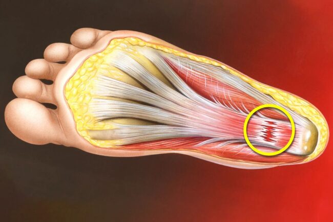 Plantar Fasciitis: Causes, Symptoms, and How to Find Relief