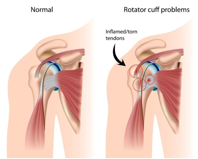 Rotator Cuff Tendinitis: Causes, Symptoms, and Treatment Rotator Cuff Tendinitis: Causes, Symptoms, and Treatment
