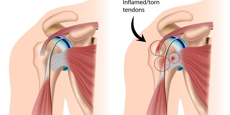 Rotator Cuff Tendinitis: Causes, Symptoms, and Treatment