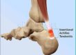 Achilles Tendonitis