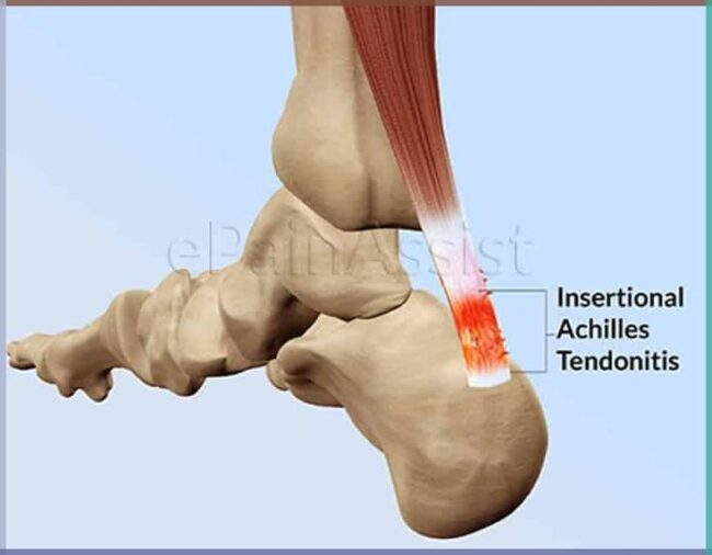 Achilles Tendonitis