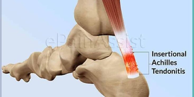 Achilles Tendonitis Achilles Tendonitis