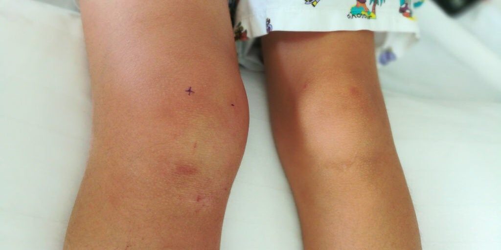 Swollen Knee Without Injury Swollen Knee Without Injury