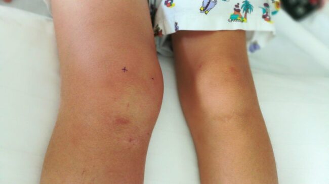 Swollen Knee Without Injury Swollen Knee Without Injury